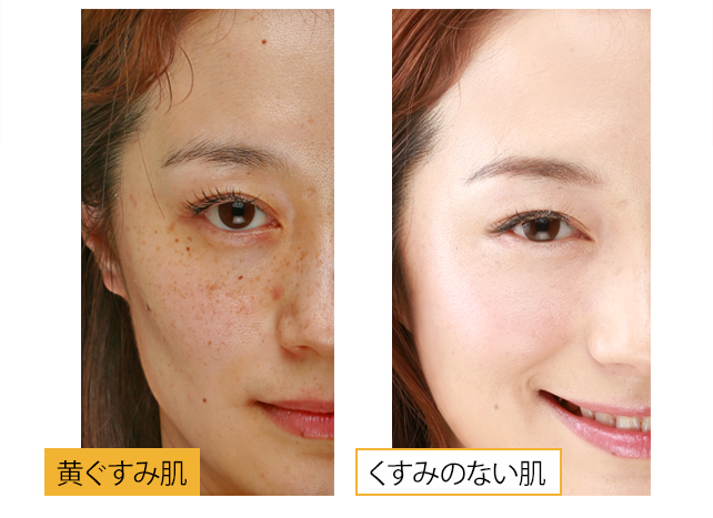 黄ぐすみ肌⇒くすみのない肌